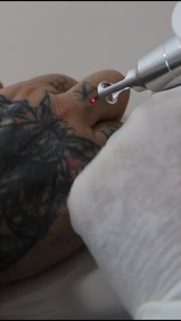 Aplicación de láser sobre tatuaje en mano, InkOFF Laser
