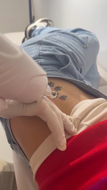 Sesión de remoción de tatuaje pequeño en InkOFF Laser